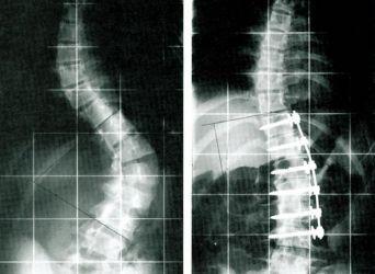 spondylodese